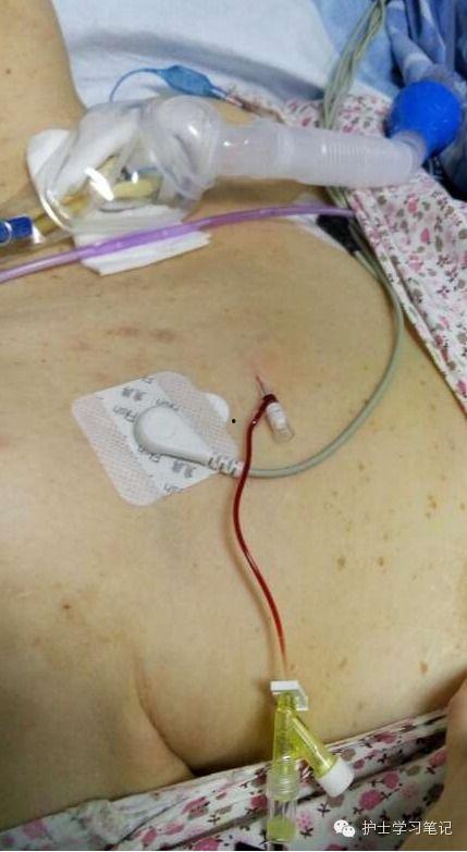 静脉留置针穿刺视频