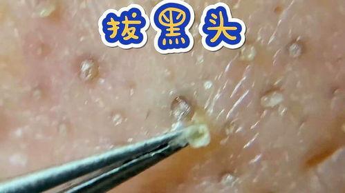 挤黑头视频高清,专业挤黑头技巧全解析