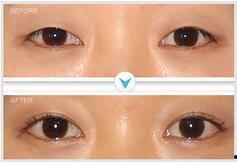 定位双眼皮视频,揭秘完美双眼皮的秘密